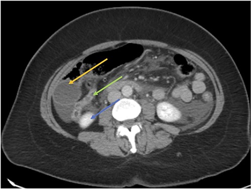 CT axial view showing the appendix (green arrow) inferior to the gallbladder (orange arrow) and superior to the right kidney (blue arrow).