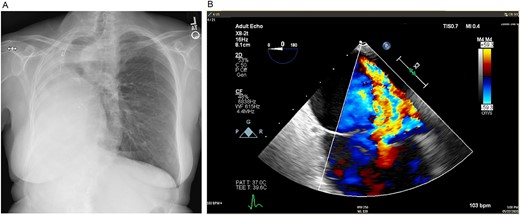 (A) Preoperative posteroanterior view chest X-ray showing left to right mediastinal contents shifted and a clear left lung. (B) Preoperative transesophageal echocardiogram with doppler showing severe tricuspid regurgitation with no coaptation between the anterior and septal leaflets.