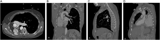 Preoperative computed tomography of the chest. Axial (A), coronal (B) and sagittal (C, D) views demonstrating displacement of the heart and left lung into the right hemithorax.