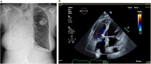 (A) Postoperative posteroanterior view chest X-ray. (B) Postoperative transesophageal echocardiogram with doppler showing a well-seated bioprosthetic valve in the tricuspid position with a mean gradient of 4 mmHg and no measurable insufficiency.
