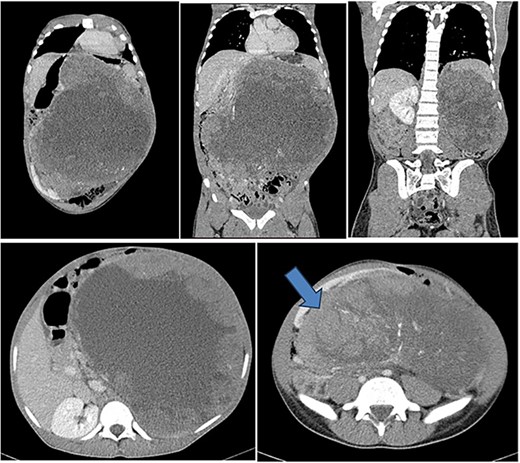 Contrasted coronal and axial CT of the abdomen and pelvis shows a huge heterogenous solid mass with central calcifications arising from the posterior cortex of the left kidney measuring 24 cm (AP) × 28.4 cm (T) × 31 cm (CC) in size. The left kidney is displaced to the right lower quadrant (blue arrow). The mass crosses the midline with displacement of the aorta and pancreas to the right side of the abdomen. The small bowels are displaced inferiorly into the pelvis. Features are suggestive of left renal tumor.