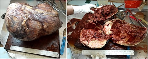 Photographs showing giant renal metanephric adenoma (specimen submitted post operatively). Radical nephrectomy specimen, irregular in shape measuring 35 × 25 × 25 cm. Cut sections revealed multifocal circumscribed solid tumor, brownish-white in color and the presence of thick brown cystic was seen. Extensive necrosis and hemorrhage were also associated along with remnant of normal appearing renal parenchymal tissue. No lymph node was identified.
