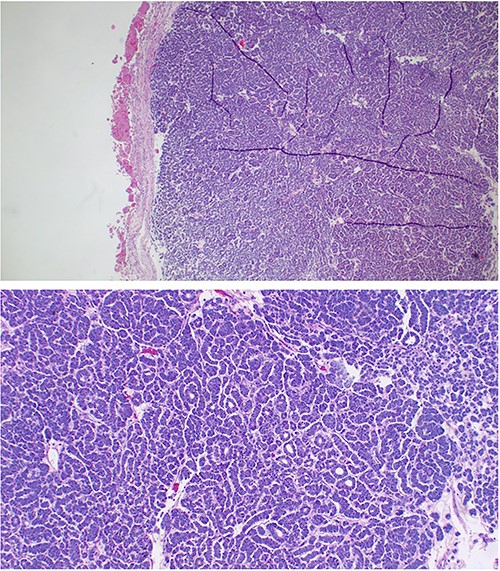 The sections showing circumscribed hypercellular tumor composed of tight parked small to intermediate cells. These were uniform round with an embryonal appearance. The nuclei were hyperchromatic with scanty cytoplasm. Tubular or acini structures were seen. Mitoses were rare. Hemorrhage and necrosis were also a feature. Immunohistochemistry with epithelial membrane antigen (EMA) and cytokeratin-7 was all negative. These features were consistent with metanephric adenoma.