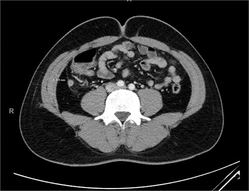CT of the abdomen demonstrating a 9.9-mm dilated appendix.