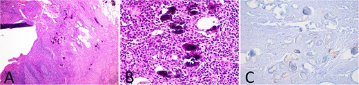 Histology slides of the appendix specimen; (A) (H&E stain, 20× magnification) features of transmural inflammatory infiltrate and serositis consistent with appendicitis and round calcified deposits within the appendiceal wall and mesoappendix; (B) (H&E stain, 400× magnification) amorphous, round, blue-black calcified deposits representing Schistosoma ova; (C) (modified Ziehl-Neelsen stain, 200× magnification) red-brown appearance of the Schistosoma ova shell.