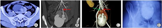 Preoperative imaging findings of the patient. (A) CTA: the left kidney is located in the pelvis with the hilum facing anteriorly; (B and C) the blood supply from the right common iliac artery (the red arrows) and the inferior mesenteric artery (the green arrow); (D) retrograde urography revealed a left ectopic kidney with hydronephrosis.
