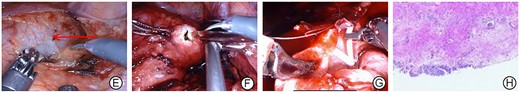Intraoperative images and postoperative pathology of the patient. (E) Significant hydronephrosis with dilated renal pelvis (the red arrow); (F) the dilated renal pelvis is incised;(G) sutured renal pelvis after the placement of double J ureteral catheter; (H) pathology is an irregular proliferation of surrounding fibrous and smooth muscle tissue.