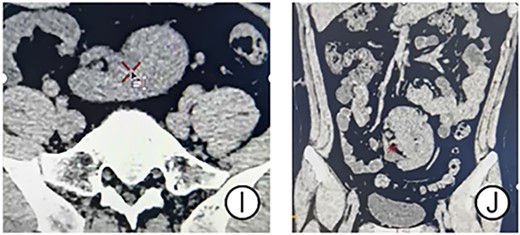 CT results of the patient’s postoperative follow-up. (I and J) CT showed significant disappearance of the effusion.
