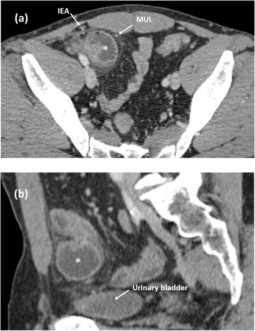 Contrast-enhanced CT images of the internal hernia in the medial inguinal fossa. (a, axial image) The herniated small intestine (asterisk) is located between the MUL and the IEA. (b, sagittal image) The herniated small intestine is apart from the urinary bladder. MUL, medial umbilical ligament. IEA, inferior epigastric artery.