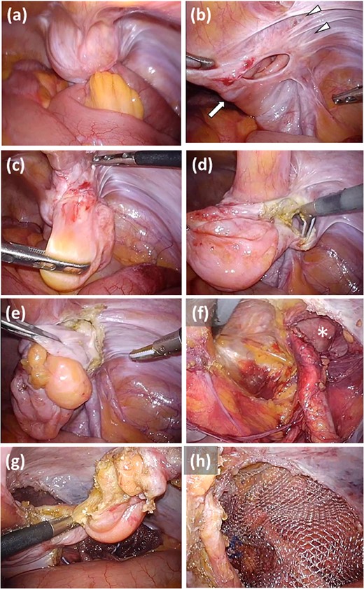 Intraoperative findings of the hernia repair. (a) The small intestine is incarcerated in the hernia sac. (b) The internal hernia sac located lateral to the right MUL (arrow) is adhered to the abdominal wall (arrowhead). (c) The internal hernia sac is inverted. (d) Another peritoneum is identified just behind the dissected internal hernia sac. (e) The peritoneum is the sac of an indirect hernia and is inverted. (f) Peritoneal dissection is performed to repair the indirect hernia (asterisk). (g) The internal hernia sac is resected. (h) The indirect hernia is repaired by using a transabdominal preperitoneal approach. MUL, medial umbilical ligament.