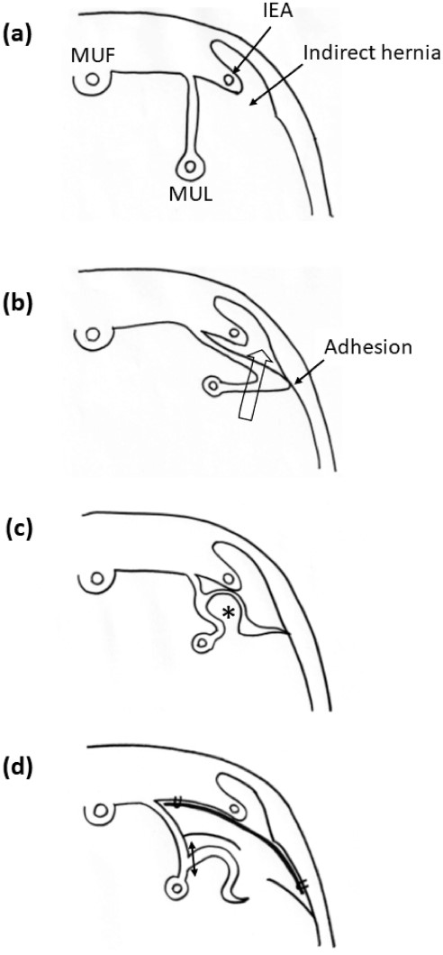 Schematic illustration of the development of interna hernia in the medial inguinal fossa. (a) An indirect hernia is originally formed. (b) The MUL is adhered to the abdominal wall, and the adhered peritoneum is drawn into the indirect hernia cavity (arrow). (c) The stretched peritoneum of the MUL provides the recess that induces the internal hernia (asterisk). (d) Mesh repair is performed for the indirect hernia, and the internal hernia sac is resected (double arrow). MUF, median umbilical fold. MUL, medial umbilical ligament. IEA, inferior epigastric artery.