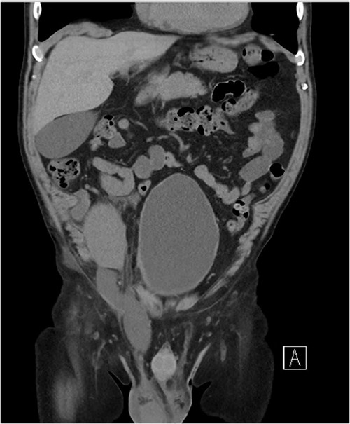Coronal CT image showing a dominant fluid collection extending off the lower pole of the transplant kidney into the right inguinal canal.