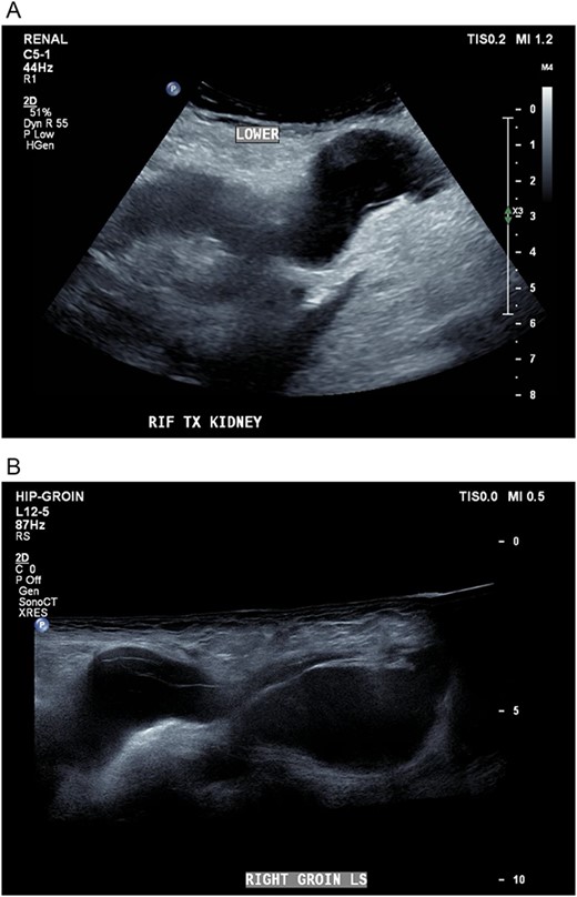 (A, B) Targeted ultrasound showing reaccumulation of a peri-transplant collection which appeared multiloculated measuring a total of 100 ml extending into the right groin.