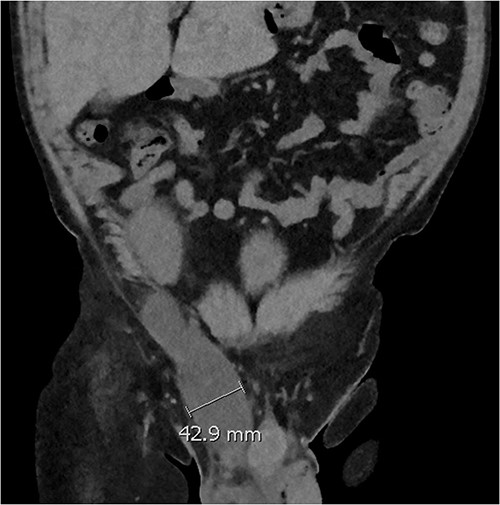 Coronal CT scan showing lobulated low-density fluid collection adjacent to the lower pole of the transplant kidney in the right iliac fossa and extending into the superficial inguinal canal tracking along the inguinal and scrotal hernia with a maximal width of 43 mm in transverse diameter.