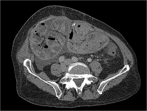 Portal phase transversal section image on CT showing loops wrapped in a membrane-like structure and thickened peritoneum.