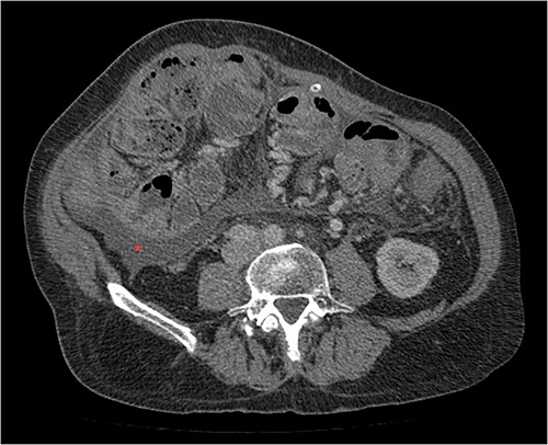 Portal phase transversal section image on CT showing membrane-like structure and loculated ascites (asterisk).