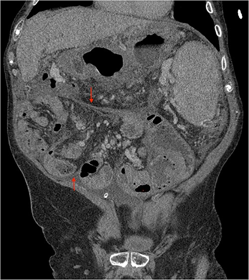 Portal phase coronal section image on CT showing loops wrapped in a membrane-like structure (arrow).