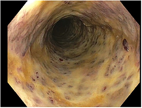 Colonoscopy: diffuse circumferential ulceration and a necrotic lining.