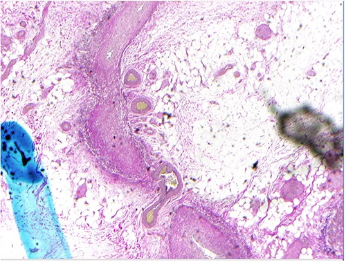 Left colonic biopsy.
