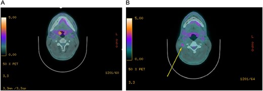 Staging imaging. (A) PET-CT imaging of the right tonsil primary lesion. (B) PET-CT imaging of the right level IIb avid node.