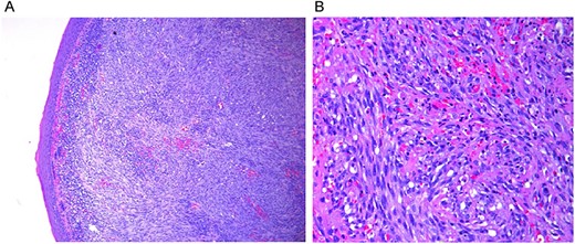 Histopathology of the primary lesions. (A) Low power view. (B) High power view.