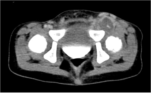 Axial computed tomography showing a large left common femoral artery mycotic aneurysm with a dense inflammatory reaction.