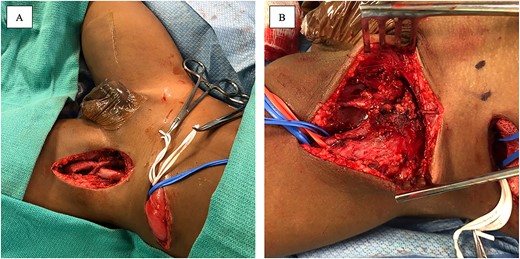 Intraoperative photograph demonstrating the completed anastomosis between the left common iliac artery and the profunda femoris artery, along with femoral vein reconstruction (A). Intraoperative photograph demonstrating large mycotic aneurysm involving the femoral artery (B).