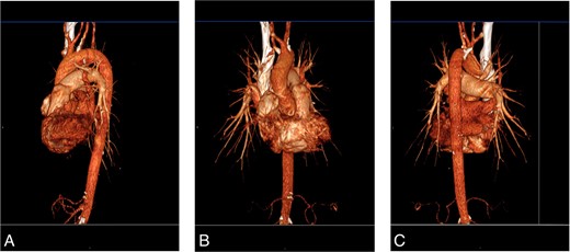 (A) CTA, left lateral view. (B) CTA, anterior view. (C) CTA, left posterior oblique view.