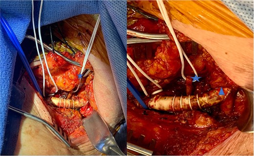 Intraoperative view of subclavian carotid bypass using PTFE graft. Blue vessel loop indicates subclavian artery to graft anastomosis. White vessel loop with blue star identifies the non-dominant vertebral artery. Blue triangle indicates graft to carotid artery anastomosis.