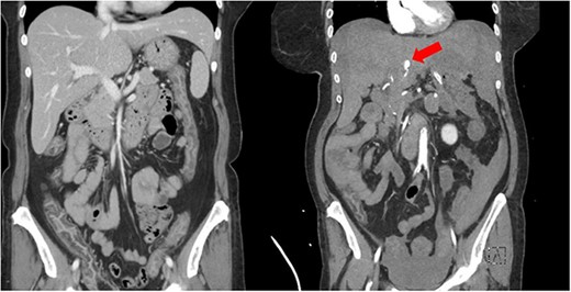Imaging showing initial CT scan (left) and repeat CT angiogram (right) several hours later. Red arrow is identifying left HAP.