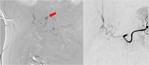 Conventional angiographic images. Left HAP identified on hepatic artery angiogram (left). Following angioembolization, there is no further evidence of bleeding from the liver via celiac artery angiography (right). Red arrow is identifying left HAP.