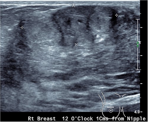 Ultrasound image showing a lobulated ovoid breast lesion.