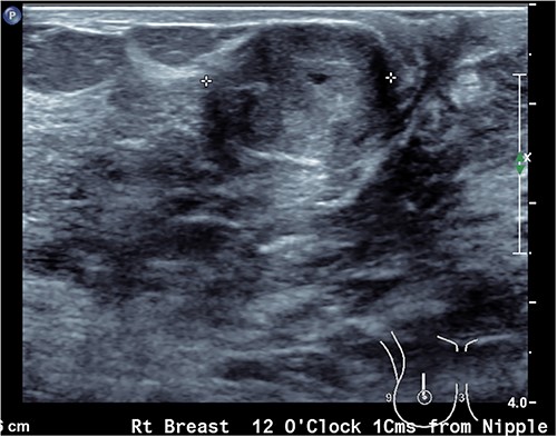 Ultrasound image of the ovoid breast lesion.