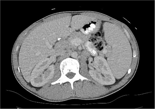 CT axial slice of abdomen and pelvis demonstrating an enlarged lymph node at the porta hepatis and splenomegaly.