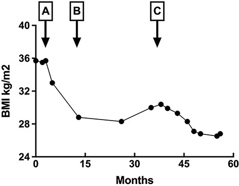 Change in body mass index (BMI). Change in patient body mass index BMI (height 152.4 cm) corresponding to inflammatory insults indicated with arrows: (A) Coxsackievirus B4 infection; (B) cholecystectomy and (C) pyelonephritis and bronchopneumonia following 5-month course of immunosuppressants. Patient maintained a predominantly plant-based diet without intentional restriction. Periods of rapid weight loss corresponded with the duration of persistent abdominal pain and diarrhea.