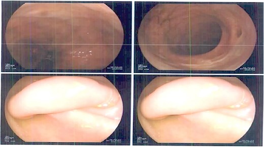 Colonoscopy February 2023.