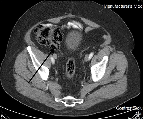 CT scan February 2010.