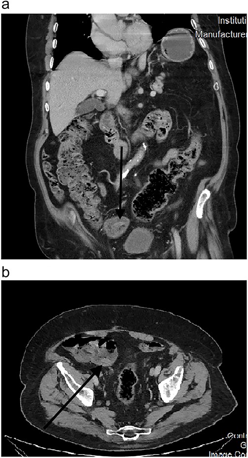 (a) CT scan February 2023. (b) CT scan February 2023.
