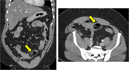 Dilated small bowel with a transition point in the distal small bowel with a rectangular object, which appeared to be an ingested foreign object.