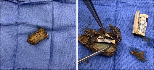 Back table inspection of the foreign body showing two rolled packets of suboxone sublingual film in two latex type balloons consistent with condoms.