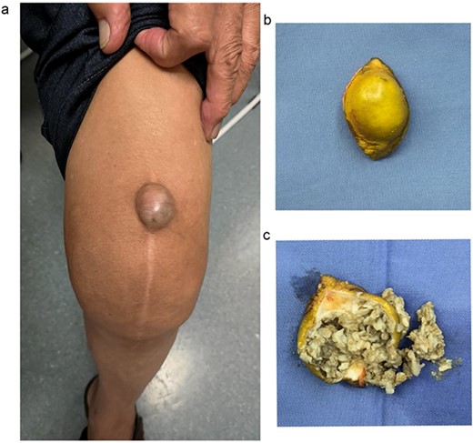 (a) A mass beneath the scar after total knee arthroplasty; (b) completely excised cyst with skin over it; (c) the appearance of cyst contents.