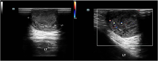 Ultrasound image of the epidermal cyst. US shows a 2.5 × 2.5 × 1.6 cm heterogeneous hypoechoic mass with regular borders.