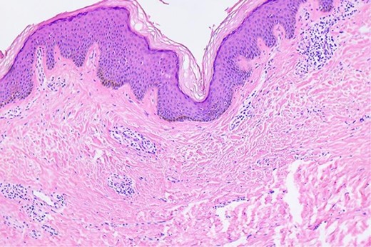 Microscopic findings of the epidermal inclusion cyst. A cystic lesion is lined by benign stratified squamous epithelium filled with abundant lamellated basket weave keratin (hematoxylin and eosin staining ×40).