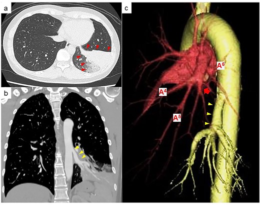 (a) Chest CT at the time of haemoptysis showing a pulmonary infiltrative shadow because of haemorrhage in part of the left basal lung segment (red arrowheads). (b) Contrast-enhanced CT showing an anomalous artery branching from the descending aorta (yellow arrowheads). (c) Three-dimensional CT showing that the original basal part of the pulmonary artery is atrophic (red arrow), and the basal part of the pulmonary artery and anomalous artery (yellow arrowhead) is clearly separated in the distribution of blood flow within the left lower lobe.