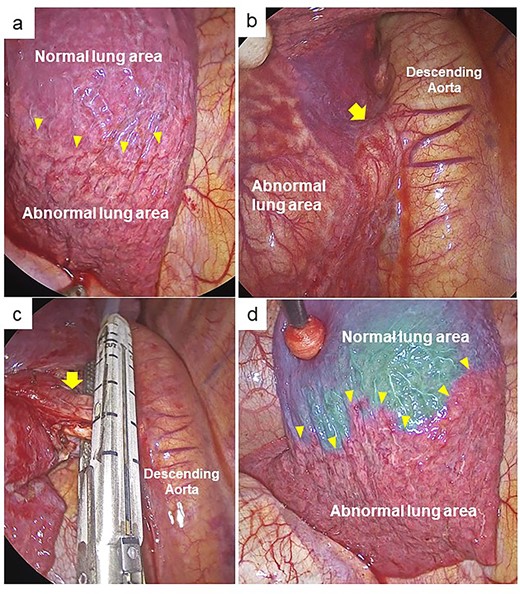 Intraoperative findings. (a) The thoracoscopic view showing clear boundary between the abnormal and normal lung area in the left basal lung (yellow arrowheads). (b) The anomalous artery (yellow arrow) was identified. (c) The anomalous artery (yellow arrow) was divided using a stapler. (d) Fluorescence navigation immediately after intravenous injection of ICG after dividing the abnormal artery. The abnormal basal lung area exhibited no fluorescence and was clearly separated from the normal lung area (yellow arrowheads).