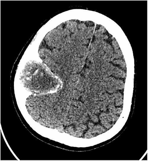 Axial CT scan showing the extra-axial lesion with surrounding bone remodelling.