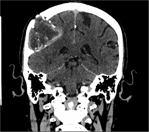 Sagittal CT scan showing the extra-axial lesion with surrounding bone remodelling and evidence of the bone erosion as well.
