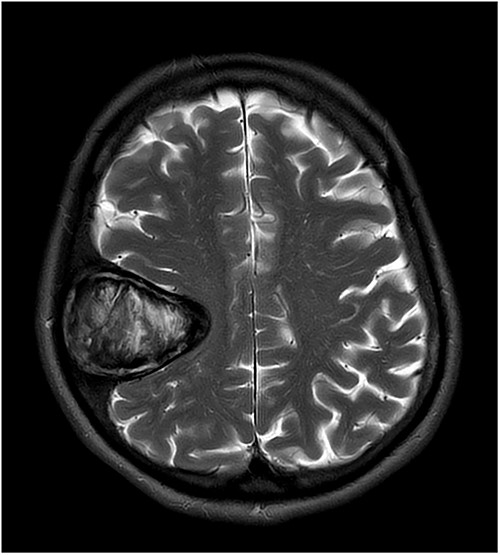 T2-weighted axial MRI scan showing the lesion with intralesional haemorrhagic products. There is no evidence of dural invasion.