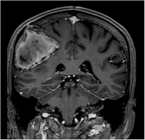 T1-weighted contrast-enhanced coronal MRI scan showing the lesion with intralesional haemorrhagic products. There is no evidence of dural invasion.