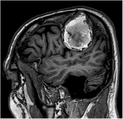 T1-weighted contrast-enhanced sagittal MRI scan showing the lesion with intralesional haemorrhagic products. There is no evidence of dural invasion.